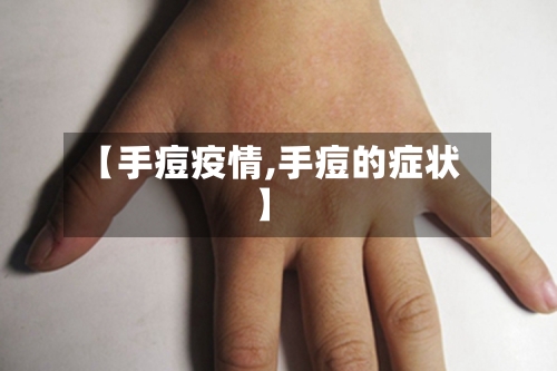 【手痘疫情,手痘的症状】-第3张图片