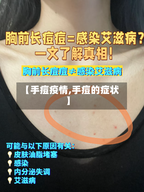 【手痘疫情,手痘的症状】-第2张图片